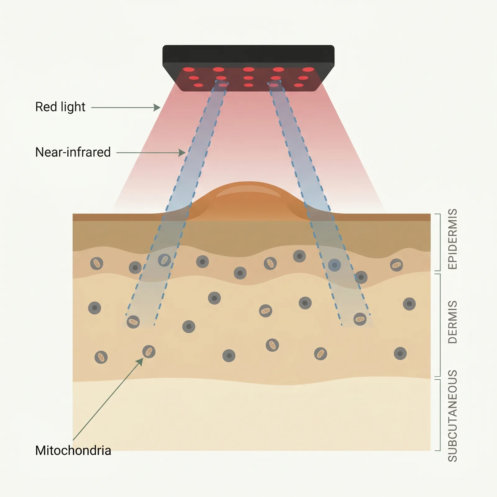 Cross-section of skin showing an LED panel above, with red and near-infrared beams reaching the dermis. A keloid sits raised on the surface.
